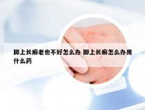 脚上长癣老也不好怎么办 脚上长癣怎么办用什么药