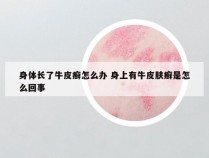 身体长了牛皮癣怎么办 身上有牛皮肤癣是怎么回事