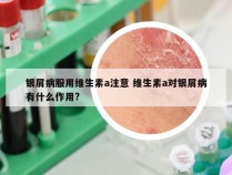 银屑病服用维生素a注意 维生素a对银屑病有什么作用?