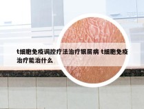 t细胞免疫调控疗法治疗银屑病 t细胞免疫治疗能治什么