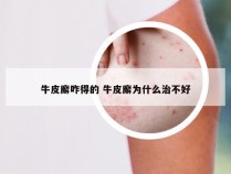 牛皮廨咋得的 牛皮廨为什么治不好