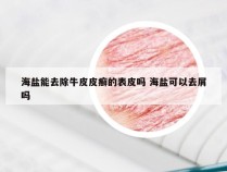 海盐能去除牛皮皮癣的表皮吗 海盐可以去屑吗