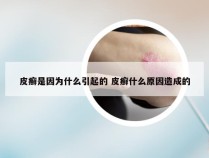 皮癣是因为什么引起的 皮癣什么原因造成的