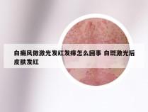 白癜风做激光发红发痒怎么回事 白斑激光后皮肤发红