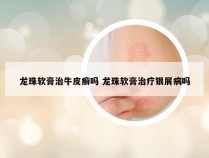 龙珠软膏治牛皮癣吗 龙珠软膏治疗银屑病吗