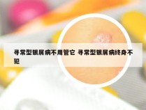 寻常型银屑病不用管它 寻常型银屑病终身不犯