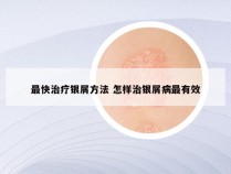 最快治疗银屑方法 怎样治银屑病最有效