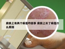 肩膀上有两个癣是咋回事 肩膀上长了癣是什么原因