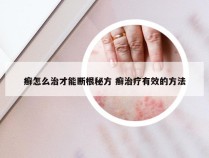 癣怎么治才能断根秘方 癣治疗有效的方法