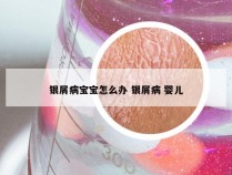 银屑病宝宝怎么办 银屑病 婴儿