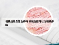 铜钱烧热点醋治癣吗 铜钱加醋可以治铜钱癣吗