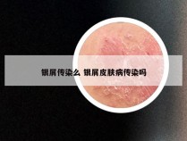 银屑传染么 银屑皮肤病传染吗