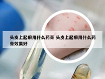 头皮上起癣用什么药膏 头皮上起癣用什么药膏效果好