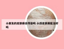 小朋友的皮肤癣会传染吗 小孩皮肤癣能治好吗