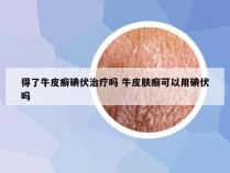 得了牛皮癣碘伏治疗吗 牛皮肤癣可以用碘伏吗