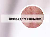 银削病怎么治疗 银削病怎么治疗快