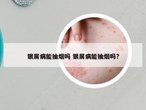 银屑病能抽烟吗 银屑病能抽烟吗?