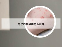 患了白癜风要怎么治好