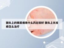 额头上的银屑病用什么药比较好 额头上长皮癣怎么治疗