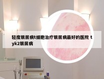 轻度银屑病t细胞治疗银屑病最好的医院 tyk2银屑病