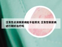 泛发性点滴银屑病能不能照光 泛发性银屑病进行期好治疗吗