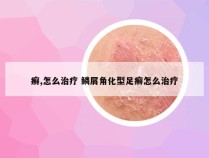 癣,怎么治疗 鳞屑角化型足癣怎么治疗