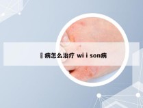 廯病怎么治疗 wiⅰson病