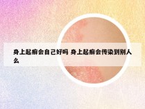 身上起癣会自己好吗 身上起癣会传染到别人么