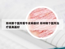 郑州那个医院看牛皮癣最好 郑州哪个医院治疗狐臭最好