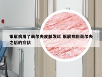 银屑病用了萌尔夫皮肤发红 银屑病用萌尔夫之后的症状