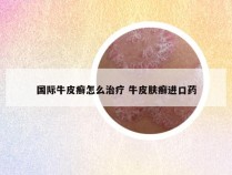 国际牛皮癣怎么治疗 牛皮肤癣进口药