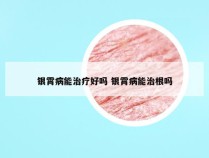 银霄病能治疗好吗 银霄病能治根吗