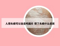 人得头癣可以自愈吗图片 得了头癣什么症状