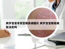 两岁宝宝寻常型银屑病图片 两岁宝宝银屑病能治愈吗