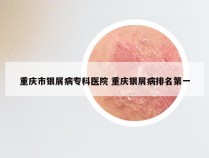 重庆市银屑病专科医院 重庆银屑病排名第一