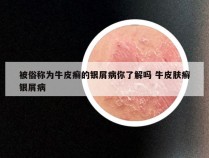 被俗称为牛皮癣的银屑病你了解吗 牛皮肤癣银屑病