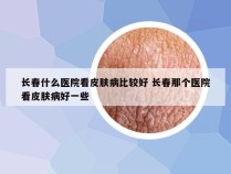 长春什么医院看皮肤病比较好 长春那个医院看皮肤病好一些