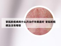 掌跖脓疱病用什么药治疗效果最好 掌跖脓疱病治法有哪些