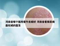 河南省哪个医院看牛皮癣好 河南省看银屑病最权威的医生