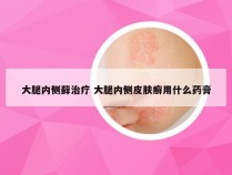 大腿内侧藓治疗 大腿内侧皮肤癣用什么药膏