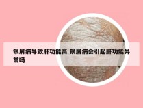 银屑病导致肝功能高 银屑病会引起肝功能异常吗