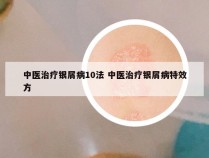 中医治疗银屑病10法 中医治疗银屑病特效方