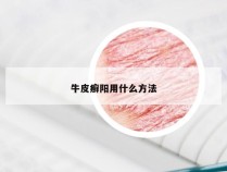 牛皮癣阳用什么方法