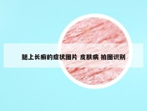 腿上长癣的症状图片 皮肤病 拍图识别