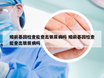 婚前基因检查能查出银屑病吗 婚前基因检查能查出银屑病吗