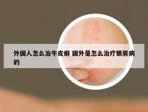 外国人怎么治牛皮癣 国外是怎么治疗银屑病的