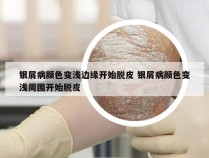 银屑病颜色变浅边缘开始脱皮 银屑病颜色变浅周围开始脱皮