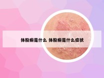 体股癣是什么 体股癣是什么症状