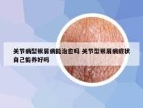 关节病型银屑病能治愈吗 关节型银屑病症状自己能养好吗