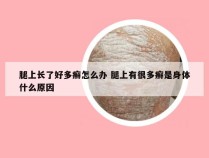 腿上长了好多癣怎么办 腿上有很多癣是身体什么原因